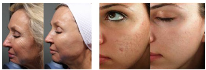 Acne scars | American Academy of Dermatology